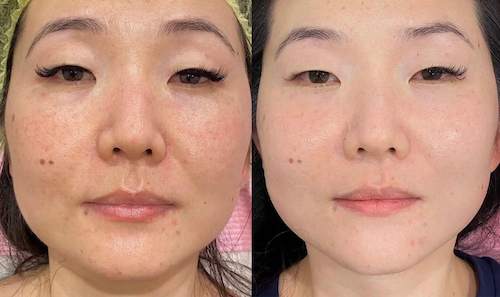 before after mesotherapy skin improvement mississauga oakville 1